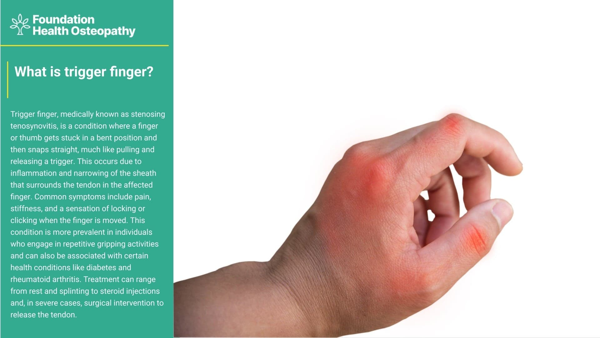 Trigger Finger | Foundation Health Osteopathy | 02 6681 6249 ...