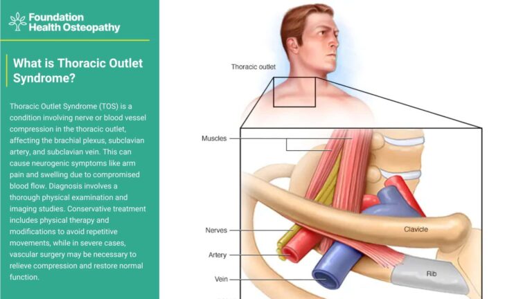 What is thoracic outlet syndrome