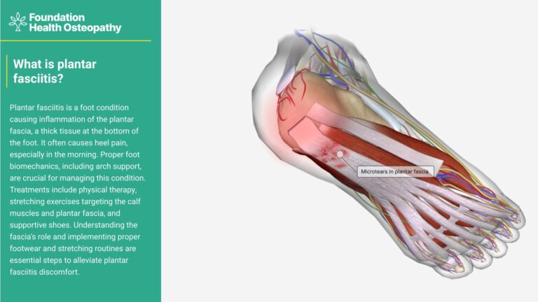 What is plantar fasciitis