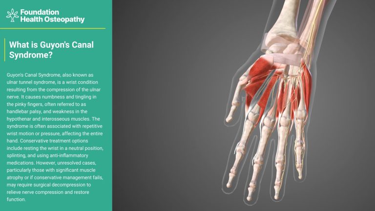 Guyon canal syndrome